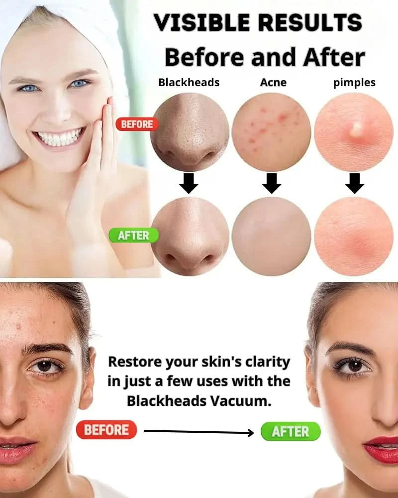 Blackhead Remover